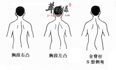 青少年脊柱弯曲应引起重视